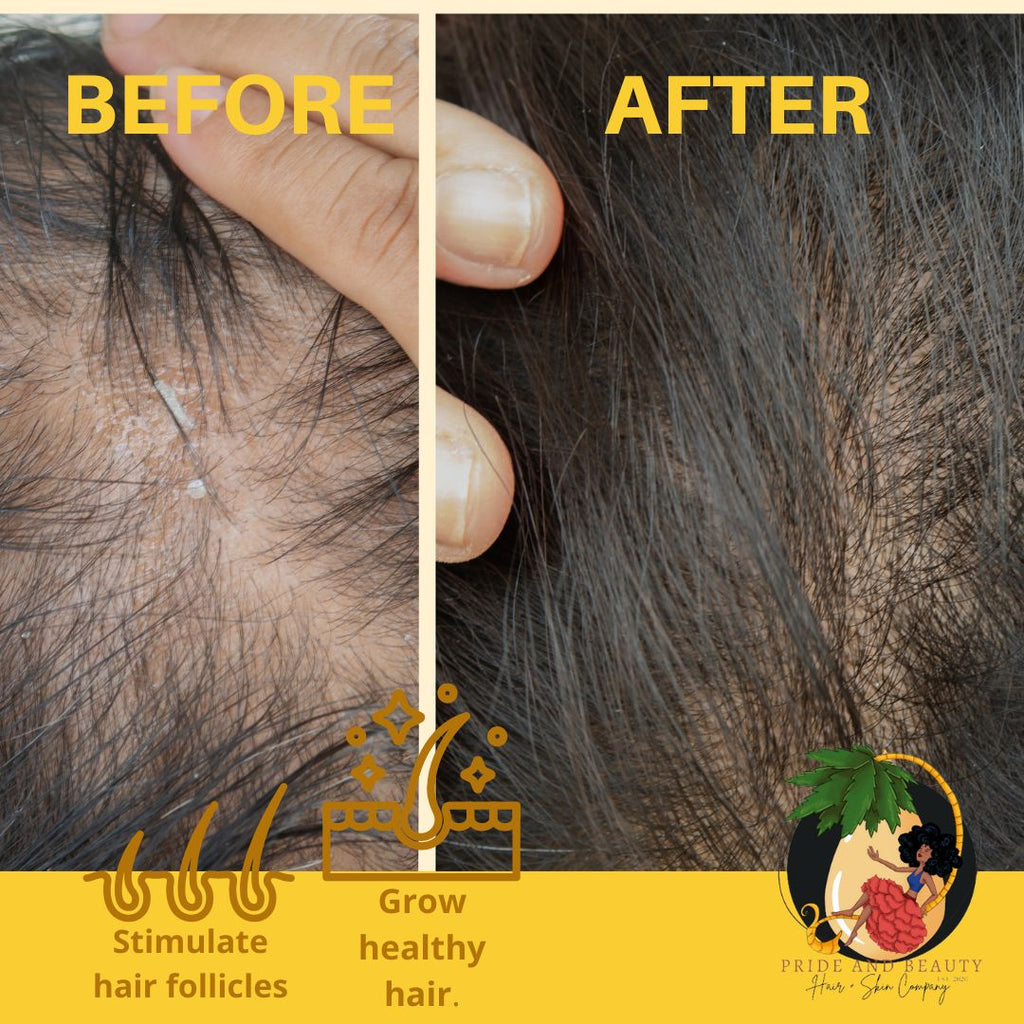 Rosemary Oil For Hair Growth - (Biotin+MSM)