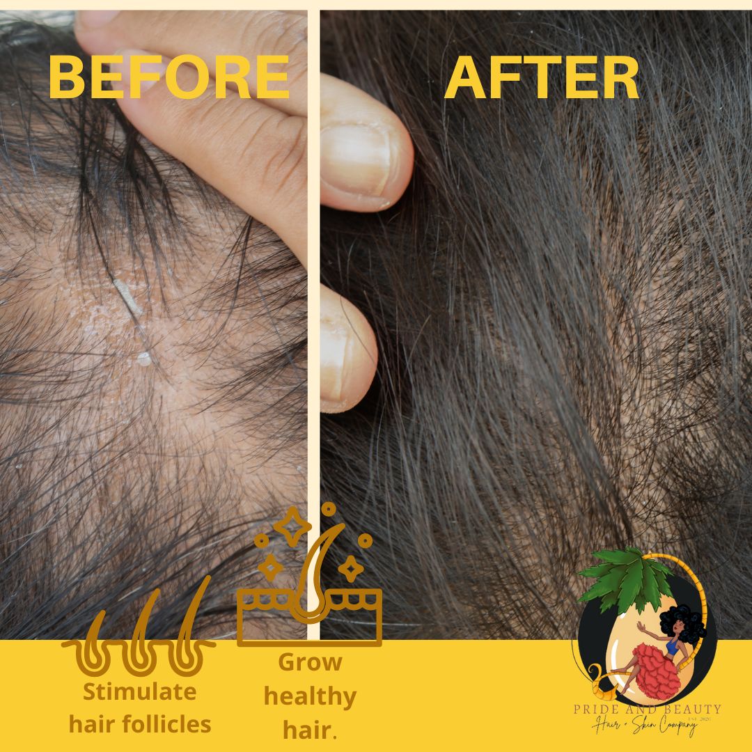 Rosemary Oil For Hair Growth - (Biotin+MSM)